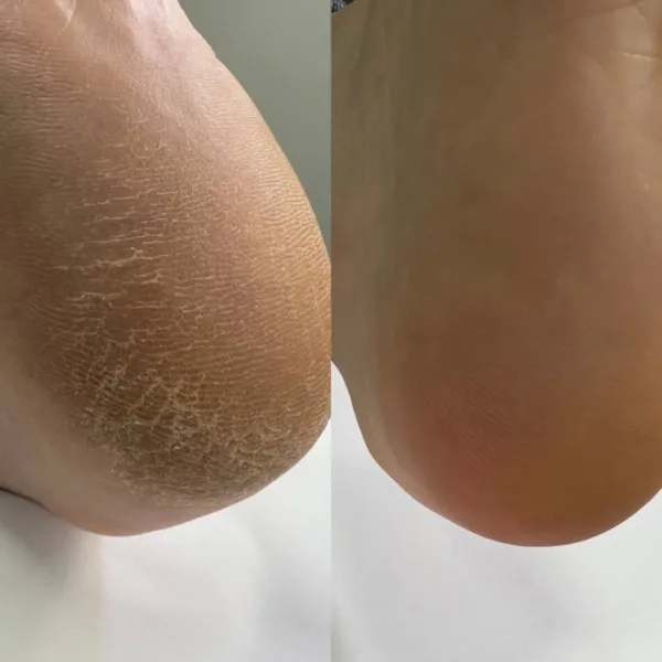 Nailsoftheday - Podology+ КЕРАТОЛІТИК для стоп, urea 20%, 100 мл - Image 5