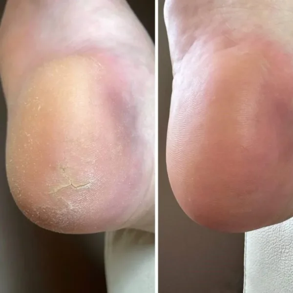 Nailsoftheday - Podology + КРЕМ від тріщин на шкірі рук та стоп, urea 12%, 30 мл - Image 3