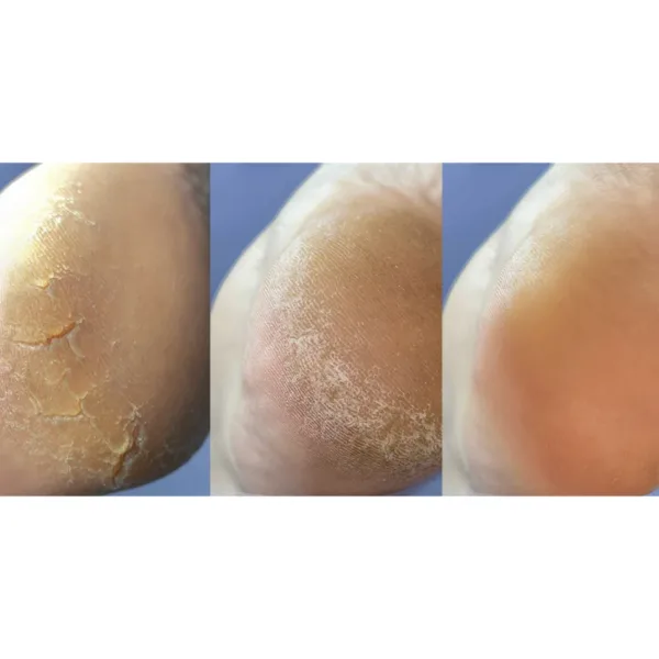 Nailsoftheday - Podology + КРЕМ від тріщин на шкірі рук та стоп, urea 12%, 30 мл - Image 4